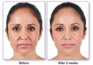 Juvederm Renaissance Plastic Surgery