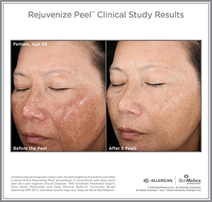 Rej_Peel_CS_Female_Age56