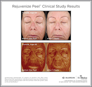 Rej_Peel_CS_Female_Age65