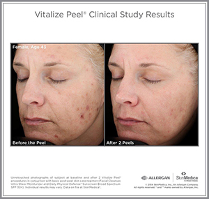 Vit_Peel_CS_Female_Age43