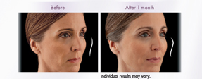 Voluma results
