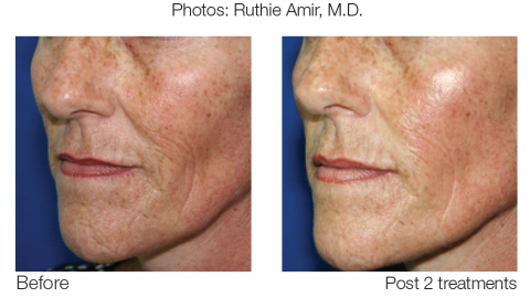 after 2 treatments