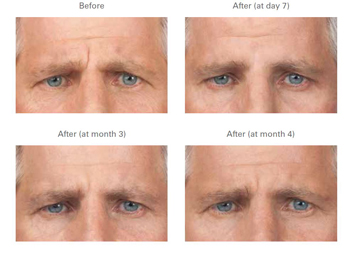 botox before and after photos