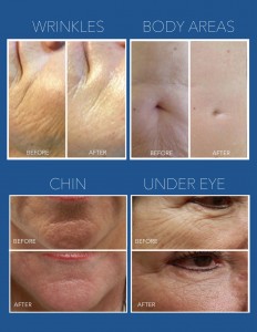 RPbefore&afters-3-2-2-3