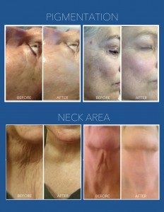 RPbefore&afters-3-2-2-4
