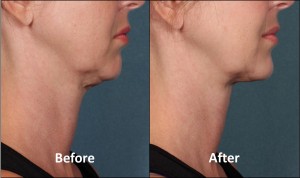 KYBELLA Patient Before and After (Side View)
