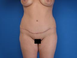 after abdominoplasty-macon