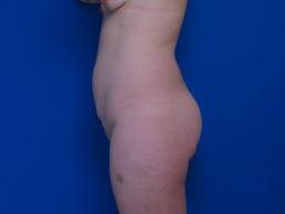 before abdominoplasty-macon