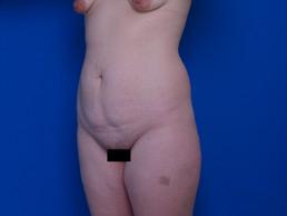 before abdominoplasty-macon
