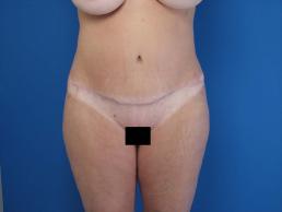 abdominoplasty-macon abdominoplasty-macon