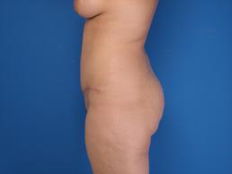 abdominoplasty-macon abdominoplasty-macon