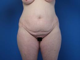 abdominoplasty-macon abdominoplasty-macon