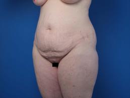abdominoplasty-macon abdominoplasty-macon
