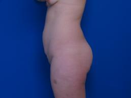 abdominoplasty-macon abdominoplasty-macon