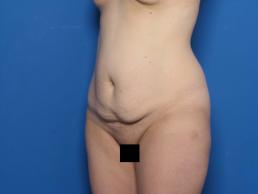 abdominoplasty-macon abdominoplasty-macon