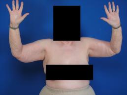 brachioplasty-macon brachioplasty-macon
