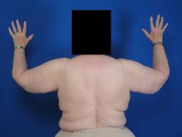 brachioplasty-macon brachioplasty-macon