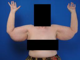 brachioplasty-macon brachioplasty-macon