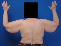 brachioplasty-macon brachioplasty-macon