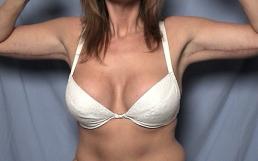 brachioplasty-macon brachioplasty-macon