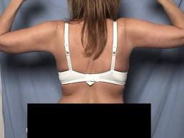 brachioplasty-macon brachioplasty-macon