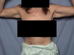 brachioplasty-macon brachioplasty-macon