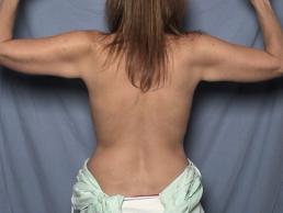 brachioplasty-macon brachioplasty-macon
