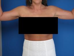 brachioplasty-macon brachioplasty-macon