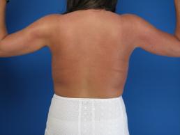 brachioplasty-macon brachioplasty-macon