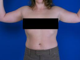 brachioplasty-macon brachioplasty-macon