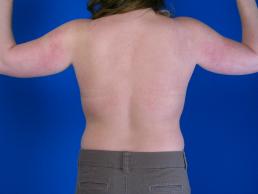 brachioplasty-macon brachioplasty-macon