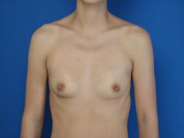 breast-augmentation-macon breast-augmentation-macon