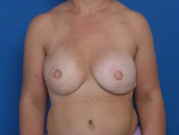breast-reconstruction-free-tram-macon breast-reconstruction-free-tram-macon