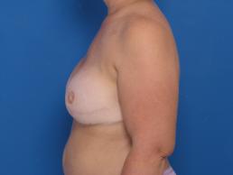 breast-reconstruction-free-tram-macon breast-reconstruction-free-tram-macon