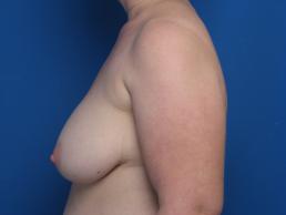 breast-reconstruction-free-tram-macon breast-reconstruction-free-tram-macon