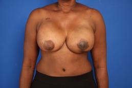 breast-reconstruction-free-tram-macon breast-reconstruction-free-tram-macon