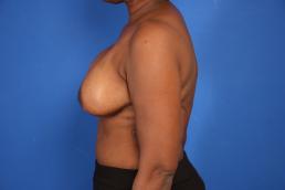 breast-reconstruction-free-tram-macon breast-reconstruction-free-tram-macon