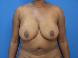 breast-reconstruction-free-tram-macon breast-reconstruction-free-tram-macon