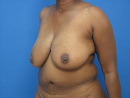 breast-reconstruction-free-tram-macon breast-reconstruction-free-tram-macon