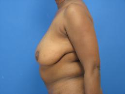 breast-reconstruction-free-tram-macon breast-reconstruction-free-tram-macon
