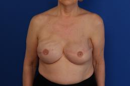 breast-reconstruction-latissimus-dorsi-flap-macon breast-reconstruction-latissimus-dorsi-flap-macon
