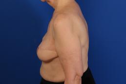 breast-reconstruction-latissimus-dorsi-flap-macon breast-reconstruction-latissimus-dorsi-flap-macon