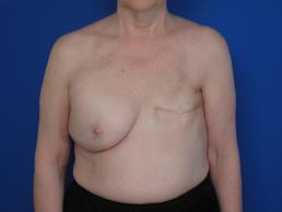 breast-reconstruction-latissimus-dorsi-flap-macon breast-reconstruction-latissimus-dorsi-flap-macon