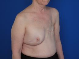 breast-reconstruction-latissimus-dorsi-flap-macon breast-reconstruction-latissimus-dorsi-flap-macon