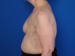 breast-reconstruction-latissimus-dorsi-flap-macon breast-reconstruction-latissimus-dorsi-flap-macon