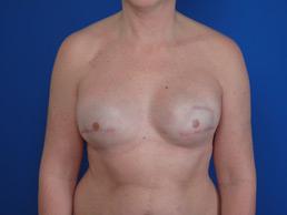 after breast-reconstruction-tissue-expander-macon