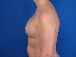 after breast-reconstruction-tissue-expander-macon