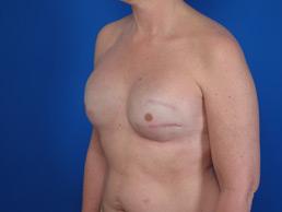 after breast-reconstruction-tissue-expander-macon