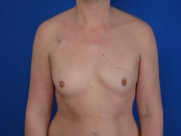 before breast-reconstruction-tissue-expander-macon