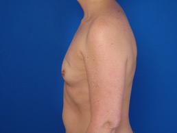 before breast-reconstruction-tissue-expander-macon
